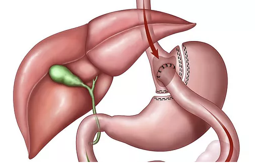 Gastric Bypass