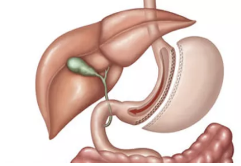 Sleeve Gastrectomy